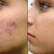 Quitar acne cicatrices peeling Bogotá
